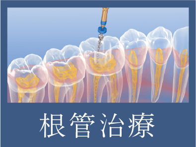 根管治療