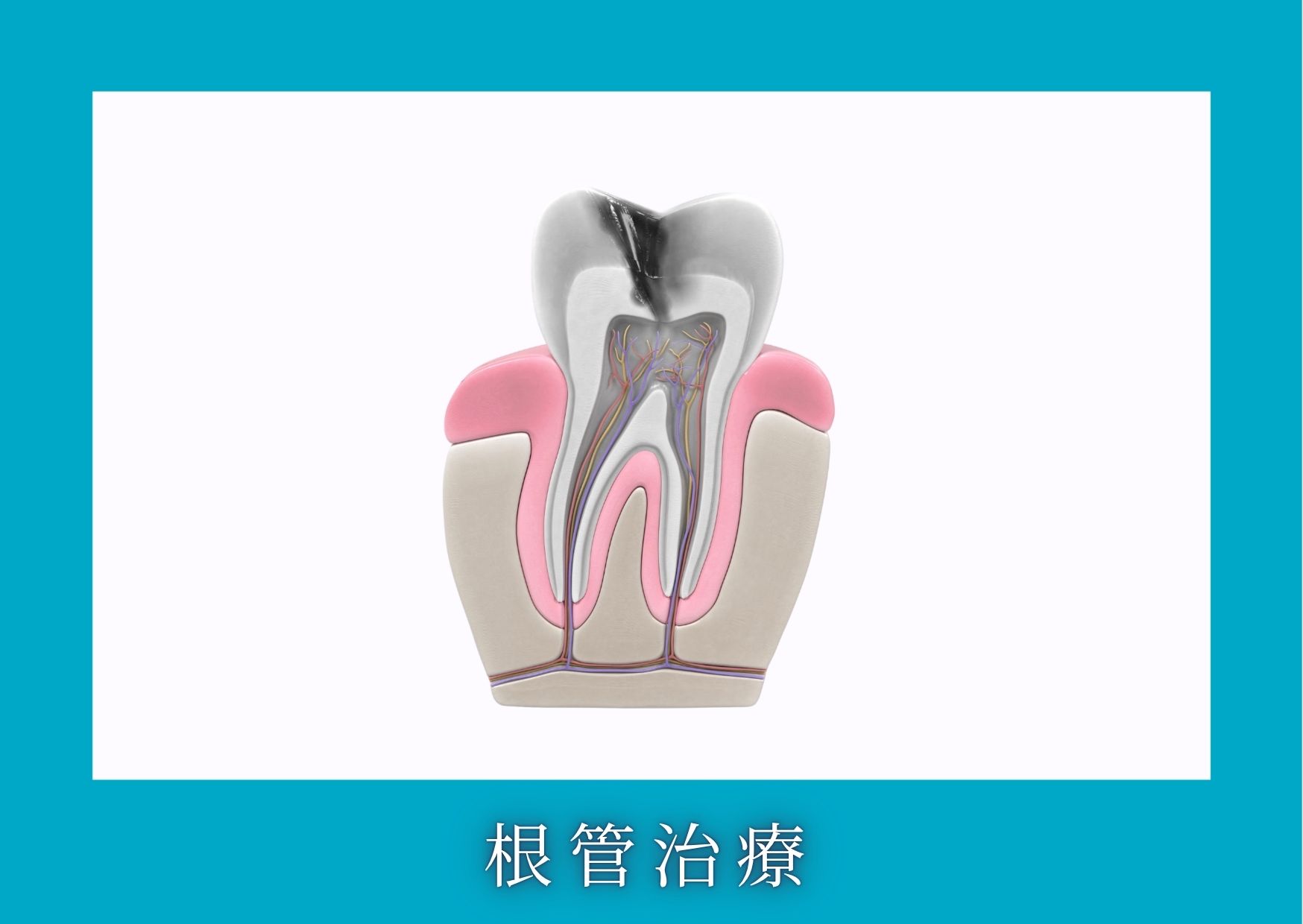 根管治療