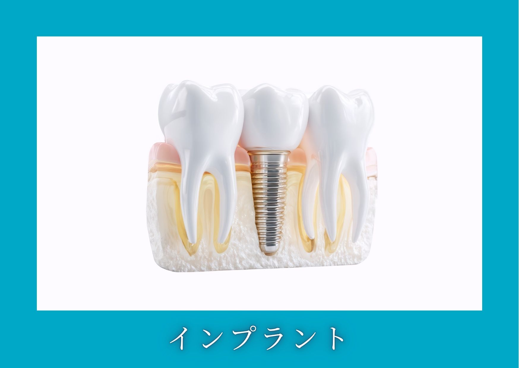 インプラント