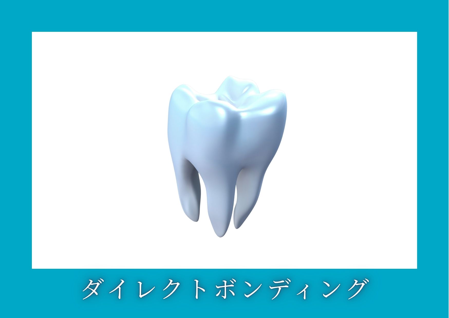 ダイレクトボンディング